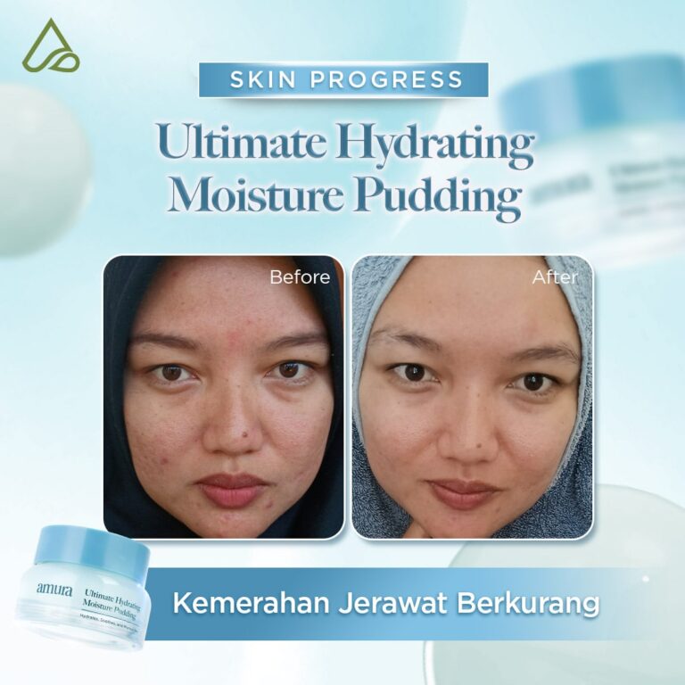 Before After Pudding Hydrating Kemerahan jerawat (2)-min